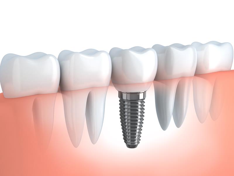 Dental Implants  Oceanside, CA